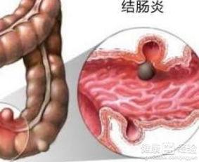 结肠炎患者可以吃鲜瓜吗,鲜瓜的适宜与禁忌